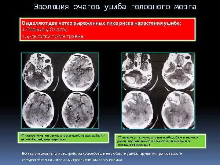Ушиб мозга на кт. Контузионные очаги головного мозга 2 типа. контузионные очаги головного мозга на кт. контузионный очаг 2 типа кт. контузионный очаг в головном мозге на кт.