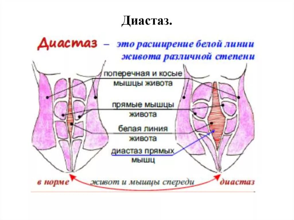 Прямая мышца живота у женщин. Норма расхождения мышц диастаз. Диастаз мышц белой линии живота. Диастаз прямой мышцы беременность. Мышцы живота анатомия диастаз.