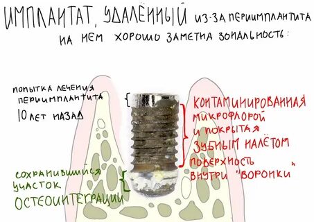 Таблетки после имплантации