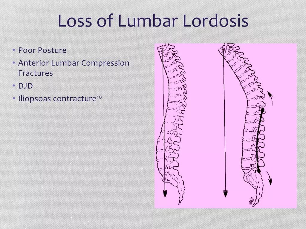 Pelvic incident - Lumbar Lordosis mismatch. Normal back Bone Lordosis. Sciatica Disc bulges Lumbar Lordosis. Lumbar Lordosis during pregnancy. Щенок по имени лордоз