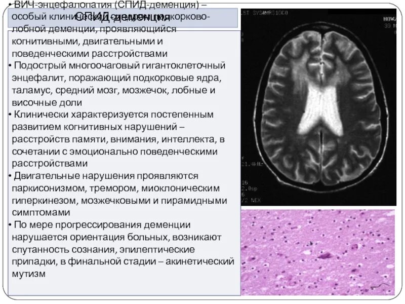 Лобно височное поражение. СПИД деменция. Лобно-височная деменция. Подкорково лобная деменция.