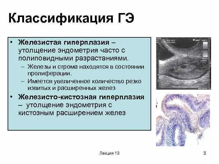 Эндометрий обрывками. Гиперплазия матки гистология. Классификация полипов эндометрия 2021. Неатипическая гиперплазия эндометрия. Стромальная гиперплазия эндометрия.