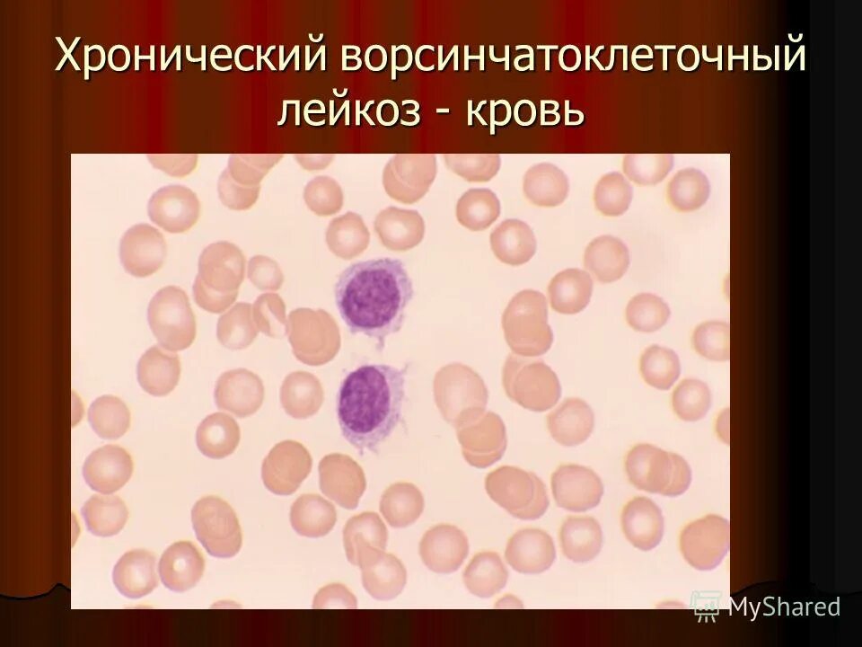 Недифференцированный лейкоз. Недифференцированный лейкоз