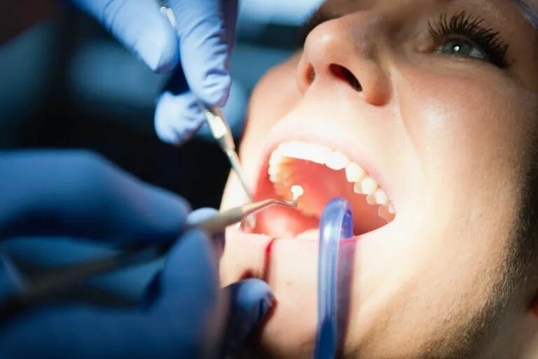 Санация полости рта это. Пломбирование зубов стоматология.