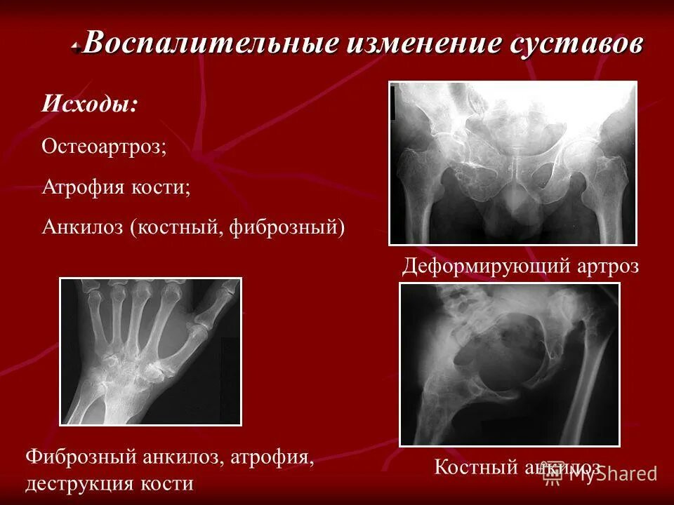 Воспалительные изменения суставов. Суставная форма ревматоидного артрита. Инфекционный и асептический характер воспаления. Воспалительное поражение костей. Воспалительные изменения суставов.