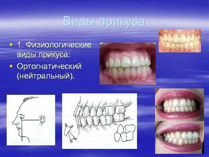 Как выглядит нормальный прикус. Физиологический ортогнатический прикус. физиологический прикус прогения. ортогнатический прикус зубы. ортогнатический прикус это норма.