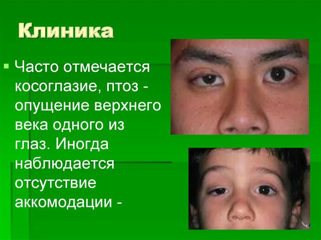 Симптомы ботулизма у человека. Ботулизм симптомы. Ботулизм клиническая картина. Клинические симптомы ботулизма. Ботулизм глазная симптоматика.