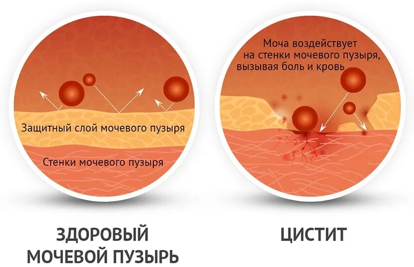 Цистит половым путем от мужчины к женщине. Женский цистит.