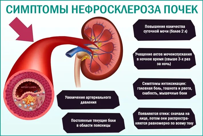 Первичная и вторичная сморщенная почка. Нефросклероз почек на УЗИ что это такое. Нефросклероз первично сморщенная почка.