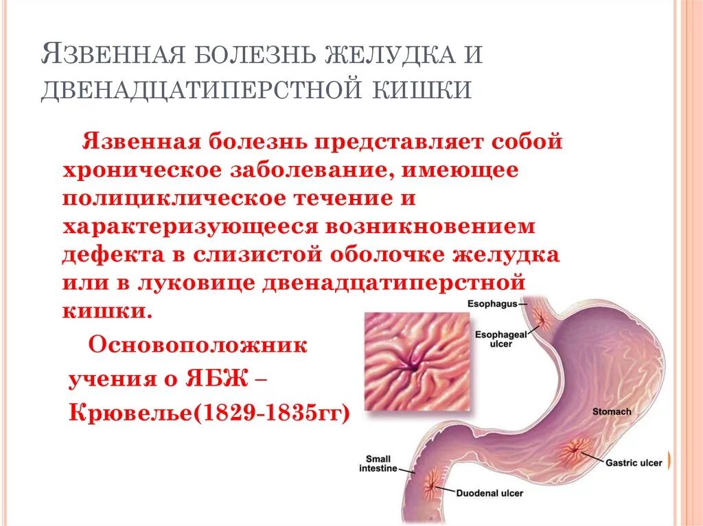 Язвенная болезнь болезнь желудка и 12 перстной кишки. Основные симптомы язвенной болезни желудка и 12-перстной кишки. Клинические симптомы язвенной болезни 12-перстной кишки. Язва двенадцатиперстной кишки к26. Профилактическая язва