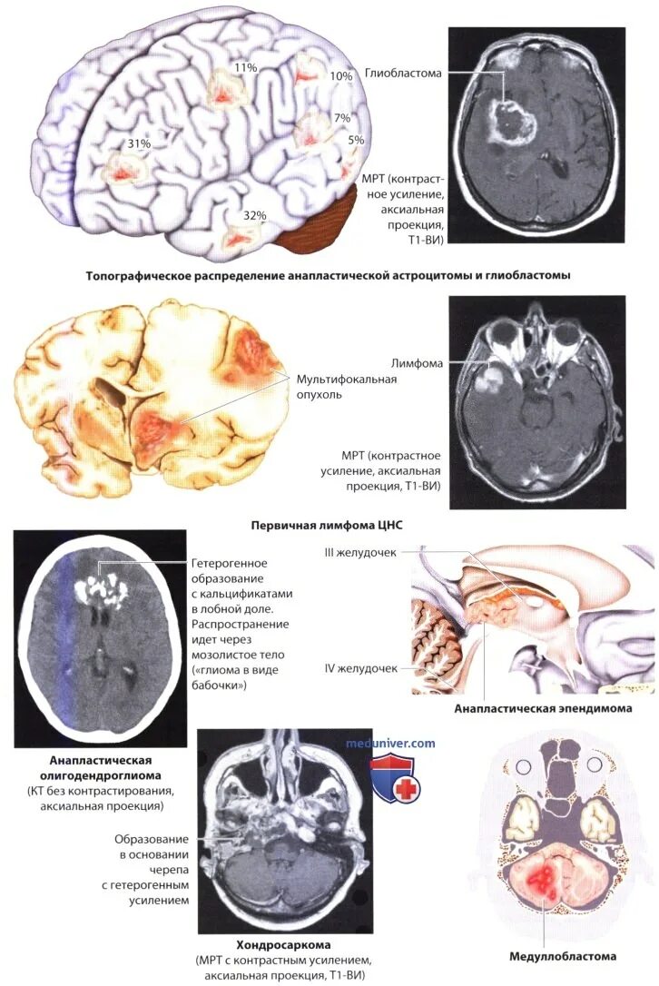 Стадии развития опухоли головного мозга. Три опухоли в головном мозге.