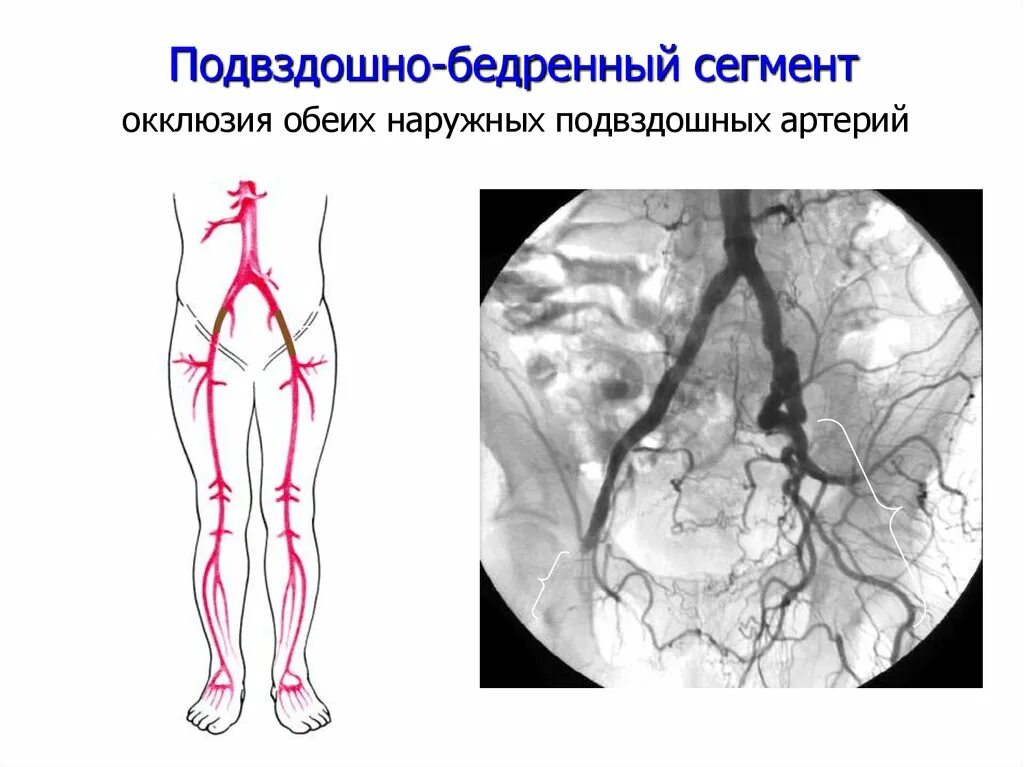 Тромбоз бедренной вены. Подвздошная артерия схема. Ангиограмма подвздошных артерий. Ангиография артерий нижних конечностей.