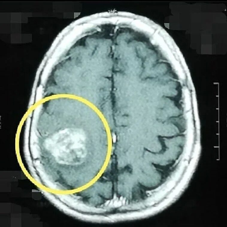 отек головного мозга форум. отек головного мозга форум. отёк и набухание головного мозга. симптом являющийся признаком развивающегося отека головного мозга. отек головного мозга форум.