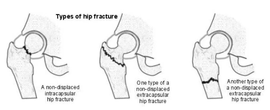 Вколоченный перелом шейки бедра. Межвертельный перелом шейки бедра у пожилых людей. Субкапитальный перелом шейки бедра операция. Переломы шейки бедра классификация рентген. Перелом шейки бедра без операции прогнозы