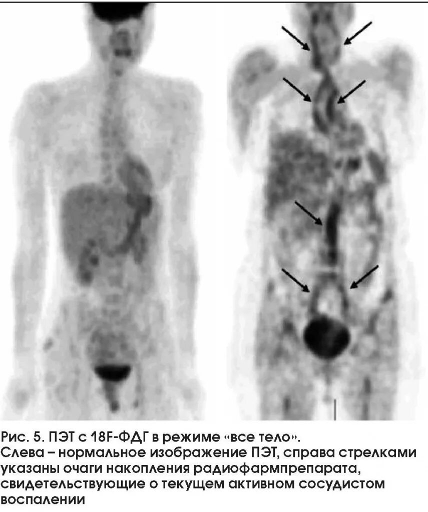 ПЭТ/кт с фтордезоксиглюкозой (18f-ФДГ). ПЭТ-кт головного мозга с 18 ФДГ. Рфп при пэт кт