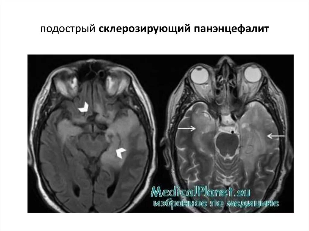 Подострый склерозирующий панэнцефалит. Подострый склерозирующий лейкоэнцефалит ван-богарта. подострый склерозирующий панэнцефалит мрт. подострый склерозирующий панэнцефалит (пспэ). подострый коревой склерозирующий панэнцефалит.