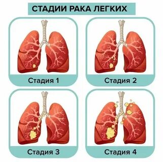 Рак легкого 3 стадии отзывы