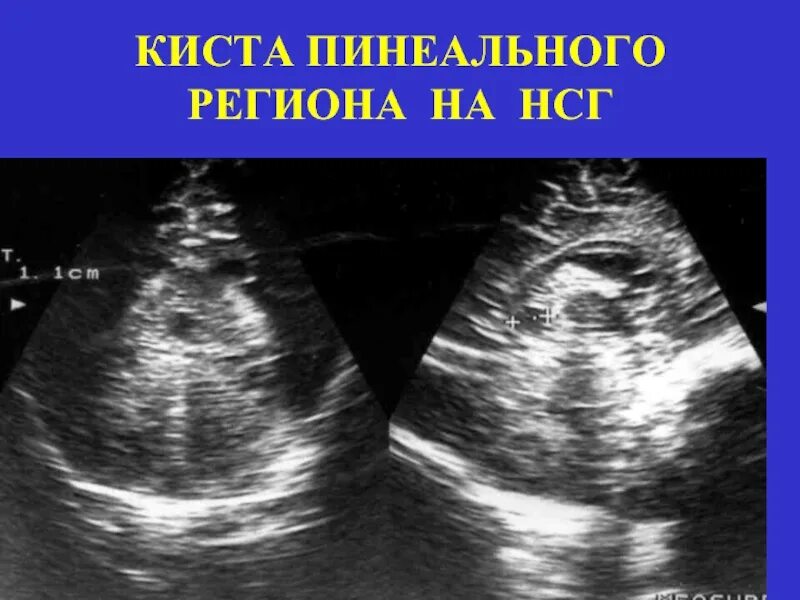 Узи субэпендимальной кисты головного мозга. Субэпендимальная киста нейросонография. Киста голова новорожденный узи. Хориоидальная киста на узи. Узи головного мозга у новорожденных.