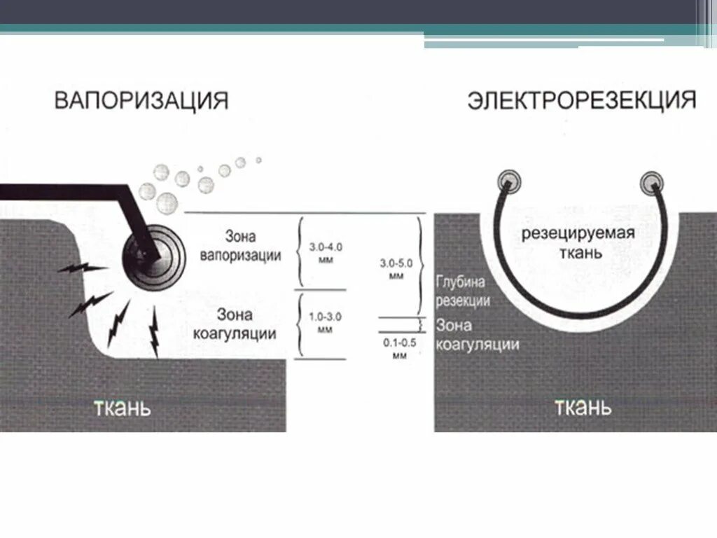 Тур вапоризация аденомы простаты это. Трансуретральная электровапоризация. Трансуретральная электровапоризация простаты. Удаление простаты реабилитация