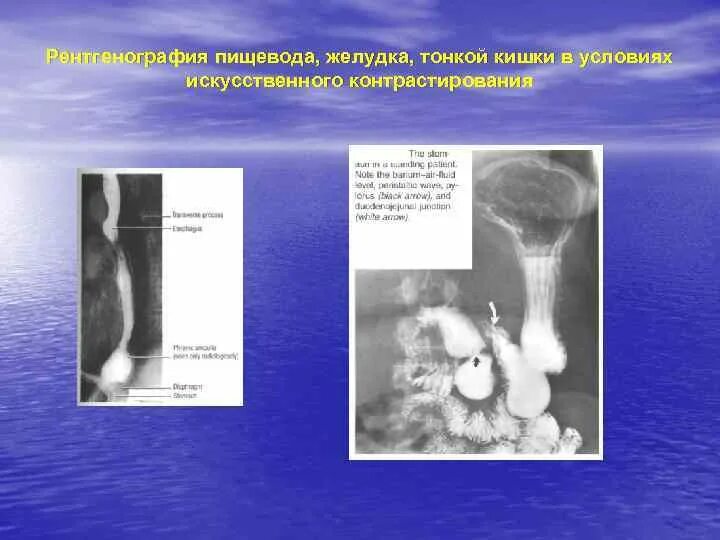 Контрастирование желудка рентген. Контрастирование пищевода рентген. Контрастирование пищевода барием. Рентгенограмма пищевода.