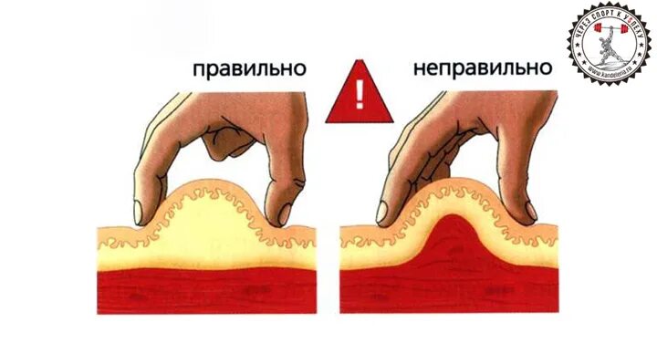 Подкожно в живот техника выполнения. Клексан подкожно в живот. Как правильно колоть Клексан в живот. Как колоть уколы в живот Клексан правильно.