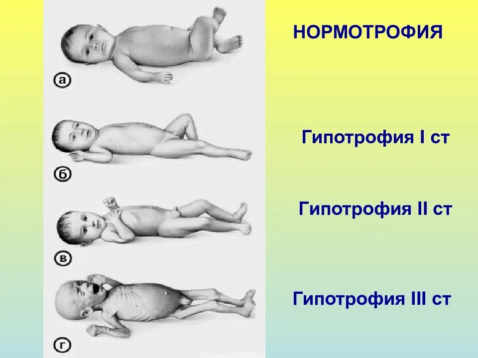 Гипотрофия. Гипотрофия 3 степени у детей. гипертрофия гипотрофия врожденная. звур гипотрофический вариант у новорожденного.