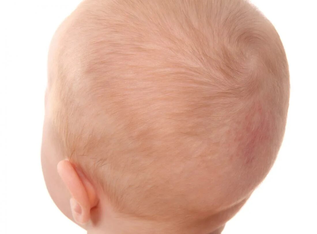 Кисточки в голове у новорожденного. Гидроцефалия головного шунт. Кисточки в голове у новорожденного. Кефалогематома у новорожденных. Псевдокиста головного мозга кт.