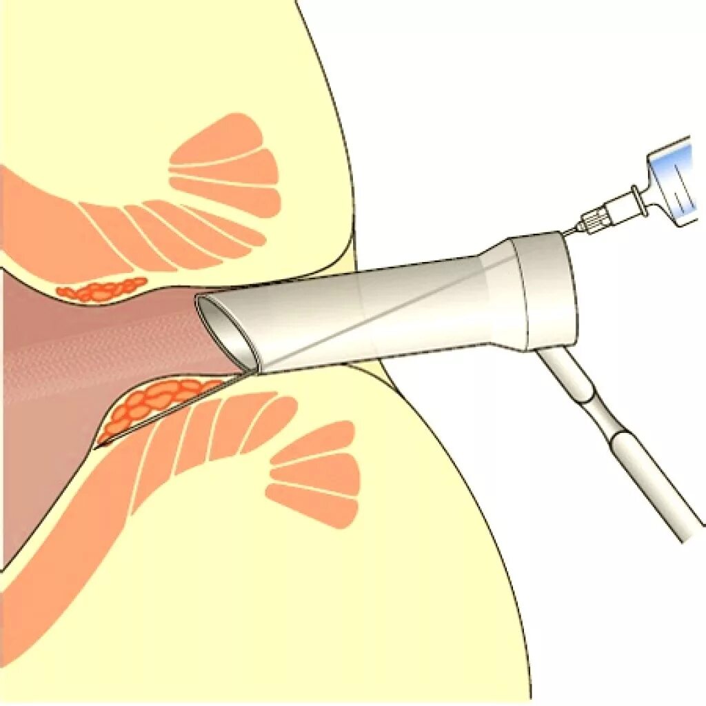 Склеротерапия геморроидальных узлов. Склеротерапия внутренних геморроидальных узлов. Лигирование склерозирование геморроя. Малоинвазивное лечение геморроя