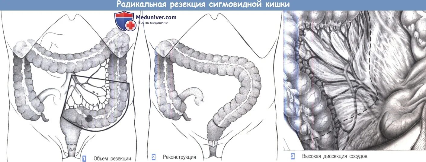 Операция толстой. Резекция сигмовидной кишки и сигмостомия. Резекция сигмовидной кишки техника операции. Дистальная резекция сигмовидной кишки. Операция при сигмовидной кишки.