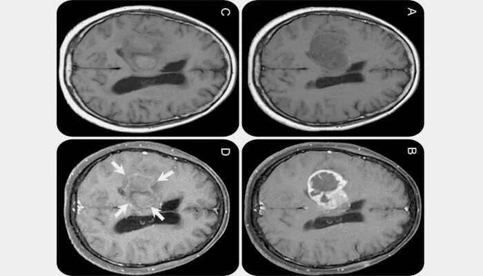 Симптомы опухоли головного мозга на ранних стадиях. Опухоль головного мозга на ранних стадиях. Опухоль головного мозга симптомы. Признаки опухоли головного мозга.