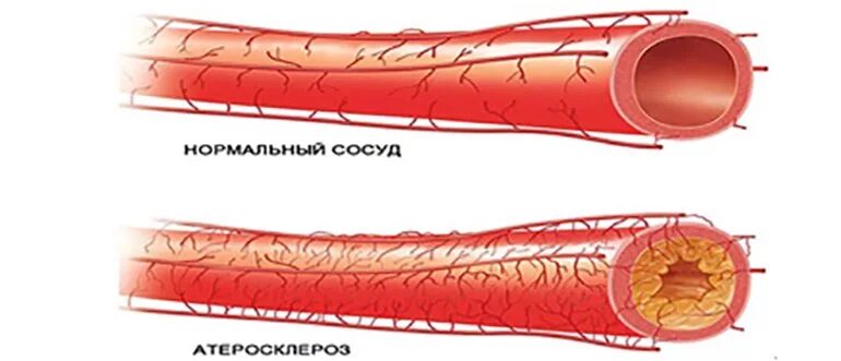 Облитерирующий атеросклероз артерий нижних конечностей. Атеросклероз сосудов нижних конечностей. Сужение сосудов симптомы причины