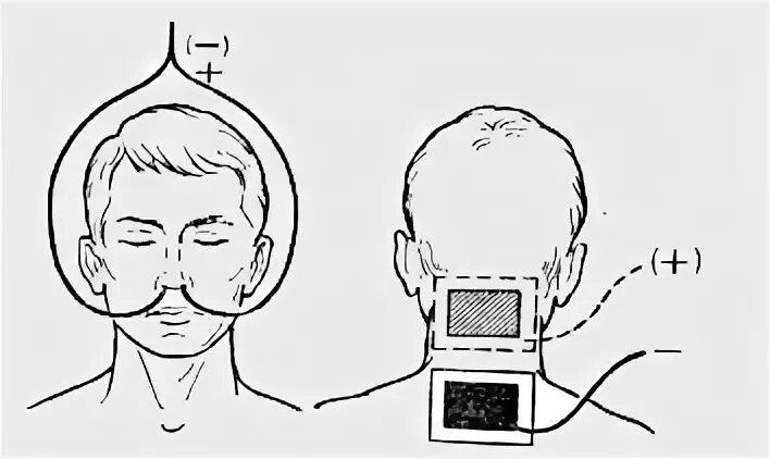Брома на воротниковую зону. Эндоназальный электрофорез методика. Электрофорез глазнично затылочная методика. Физиолечение гальванизация электрофорез. Электрофорез по Бургиньону методика.