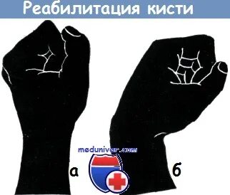 Ушиб кисти код