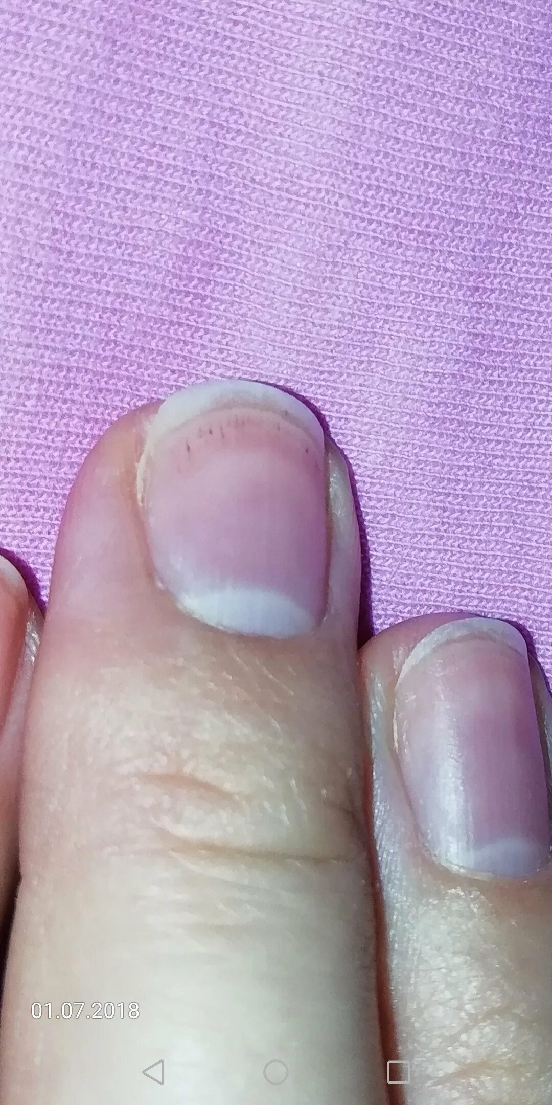Лейконихия продольная. Продольная меланонихия. Лейконихия (белые пятнышки). Темные полосы на ногтях рук.