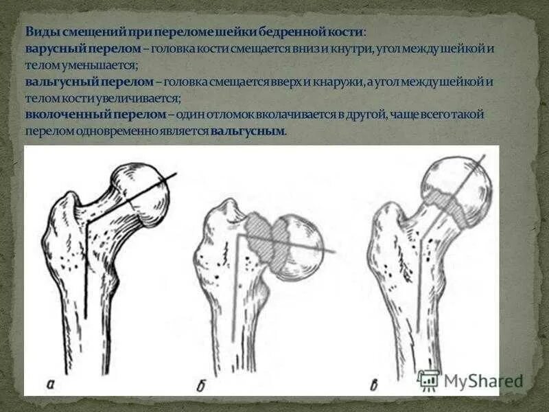 Симптомы шейки бедра как определить. Шейка бедра перелом вколоченный. Варусный перелом шейки бедра. Вальгусный перелом шейки бедра. Вколоченный вальгусный перелом шейки бедра.