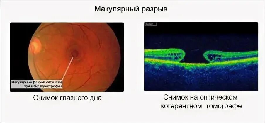 Макулярный разрыв после операции. Макулярный разрыв сетчатки ОСТ. Сквозной макулярный разрыв сетчатки. Ламеллярный макулярный разрыв сетчатки. Макулярный разрыв отслойка сетчатки.