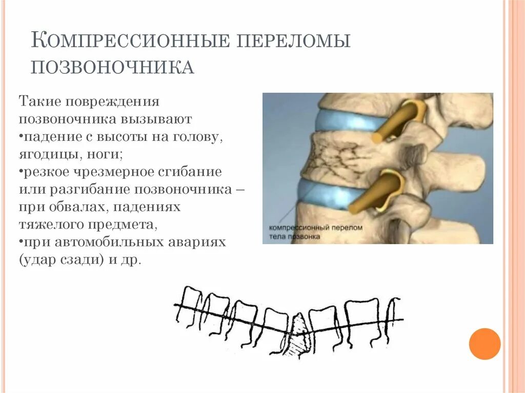 Почему нельзя сидеть при компрессионном переломе. Компрессионный перелом д6 позвонка неврологические. Компрессионный перелом th7 th8 позвонков. Компрессионный перелом позвоночника l12. Компрессионный перелом у ребенка 10-11 позвонок.