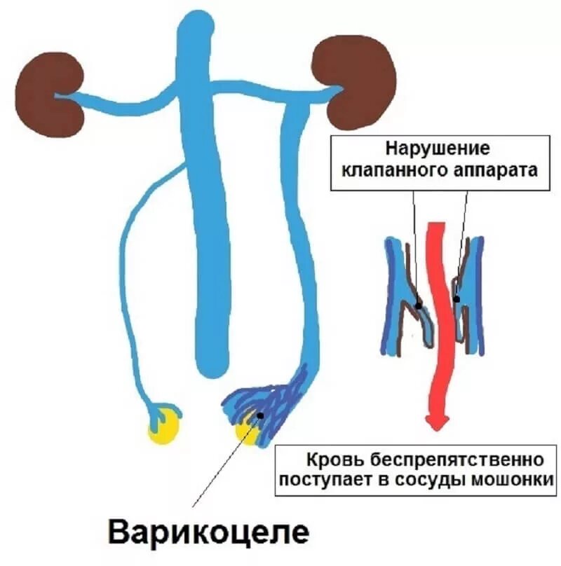 Варикоз вен семенного канатика. Расширение вен семенного канатика. Варикоцеле расширение вен. Вена левого яичка