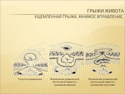 Вправление грыжи