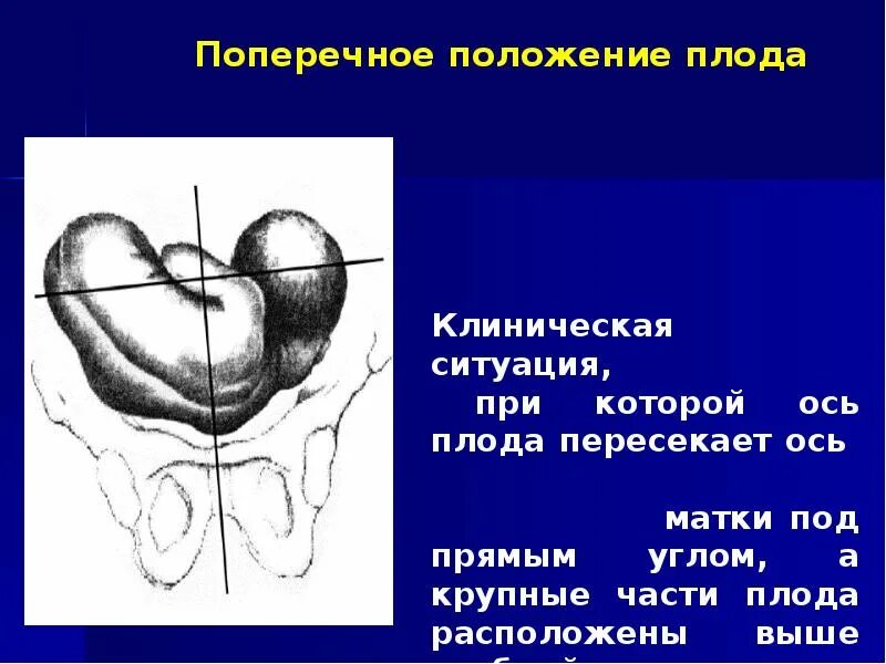 Положение эмбриона. Поперечное положение плода. поперечное и косое положение плода презентация. поперечной положение ребёнка. признаки поперечного положения плода.