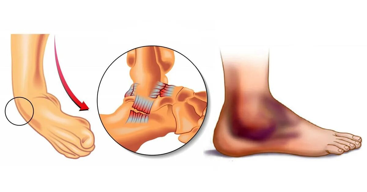 Что делает кости сильными. Подвывих голеностопного сустава гематома. Голеностоп кости растяжение. Гемартроз голеностопного сустава. Растяжение голеностопного сустава опухоль.