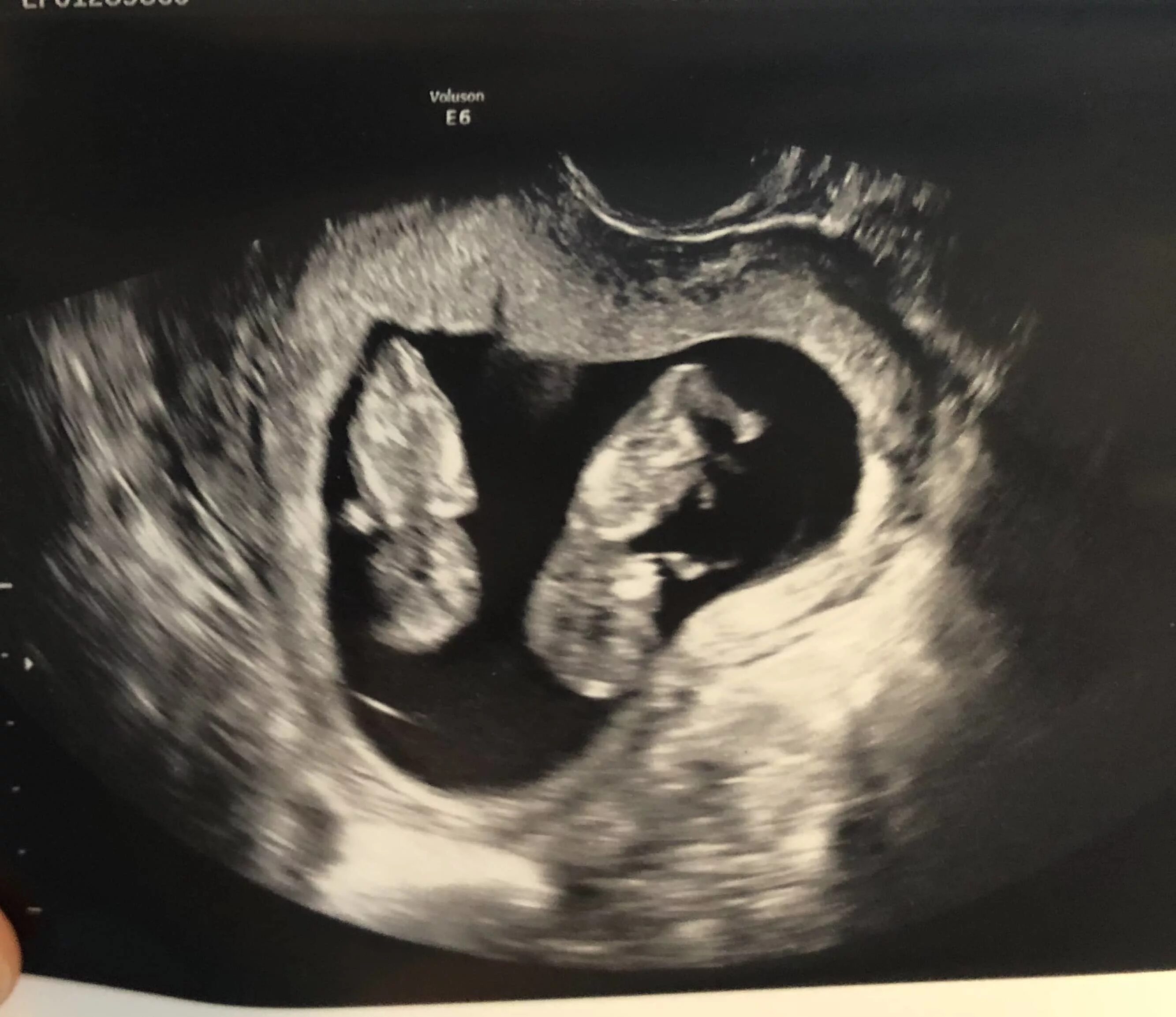 10 недель близнецы. УЗИ 11 недель беременности двойня. УЗИ 9 недель беременности двойня. УЗИ 10 недель беременности двойня. Однояйцевые Близнецы на УЗИ 11 недель.
