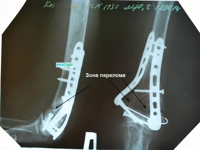 Остеосинтез операция пластины. Остеосинтез переломов дистального отдела плечевой кости. Остеосинтез плечевой кости рентген. Остеосинтез перелома плечевой кости. Чрезкостный остеосинтез.