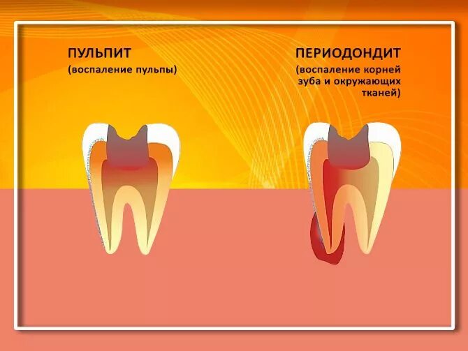 Воспаление зубов и десен. Воспаление десны в корне зуба. Антибиотики привоспалентт зуба.