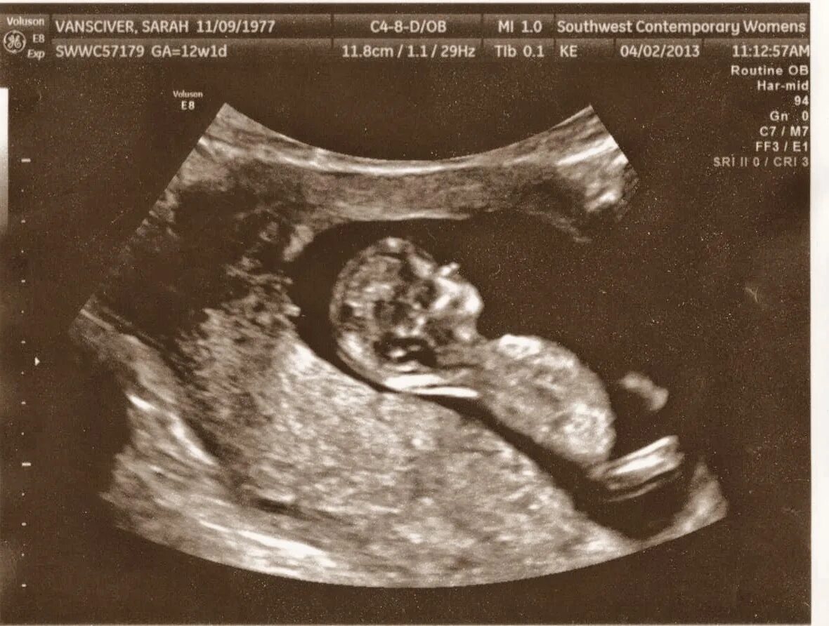 УЗИ 12 недель беременности. Снимок УЗИ на 12 неделе. Снимки УЗИ беременности 12 недель. Снимок ребенка на УЗИ 12 недель.
