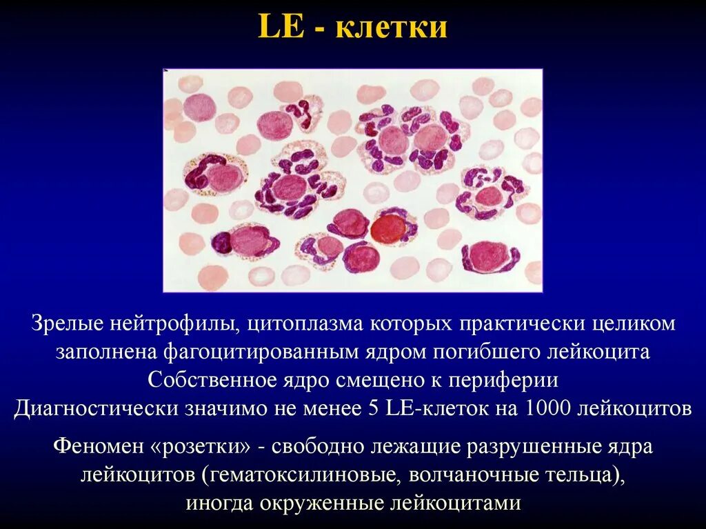 Le-клетки волчаночные клетки. Le клетки при системной красной волчанке. Le феномен клетки красной волчанки.