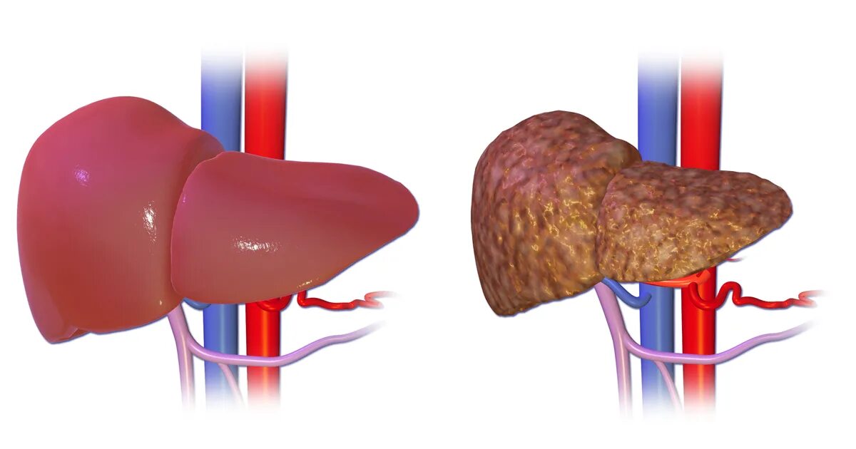 Сухой печени. Алкогольный гепатит и цирроз. Рубцевание печени (цирроз). Здоровая печень и цирроз печени. Нормальная печень и цирроз.
