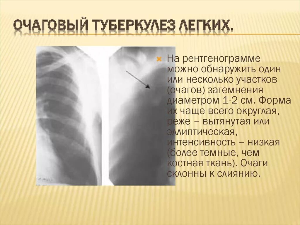 Очаговая форма туберкулеза. Очаговый туберкулез рентген признаки. Фиброзно-очаговый туберкулез легких рентген. Рентгенологические признаки очагового туберкулеза легких. Очаговый туберкулез легких рентген признаки.