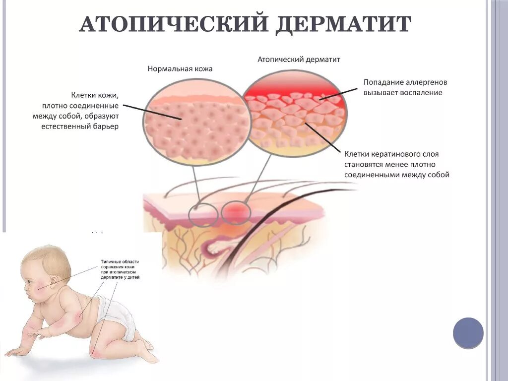 Тип аллергической реакции при атопическом дерматите. Причины атопический атопический дерматит у детей. Атопический дерматит причины ребенок 9 месяцев. Атопический дерматит причины у детей 4 года.