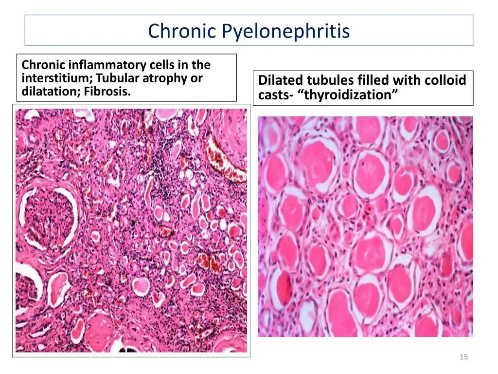 Острый гнойный пиелонефрит. Хронический пиелонефрит микропрепарат. Хронический пиелонефрит патанатомия. Острый пиелонефрит микропрепарат. Пиелонефрит у кошек и собак.